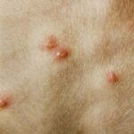 هل-يمكن-الإصابة-بجدري-الماء-مرتين؟.jpg